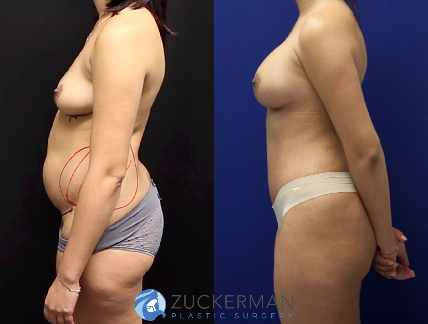 mommy makeover, before and after, breast augmentation, tummy tuck, liposuction, 1, joshua zuckerman md, nyc, left profile view