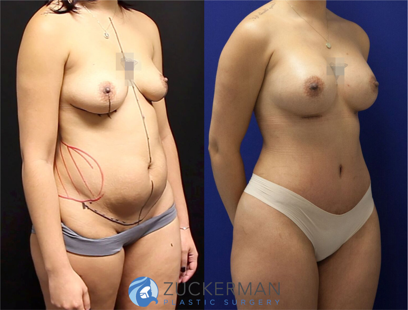 mommy makeover, before and after, breast augmentation, tummy tuck, liposuction, 1, joshua zuckerman md, nyc, right oblique view