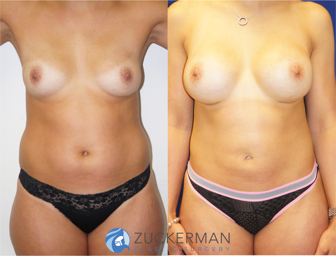 mommy makeover, before and after, breast augmentation, tummy tuck, liposuction, 2, joshua zuckerman md, nyc, frontal view