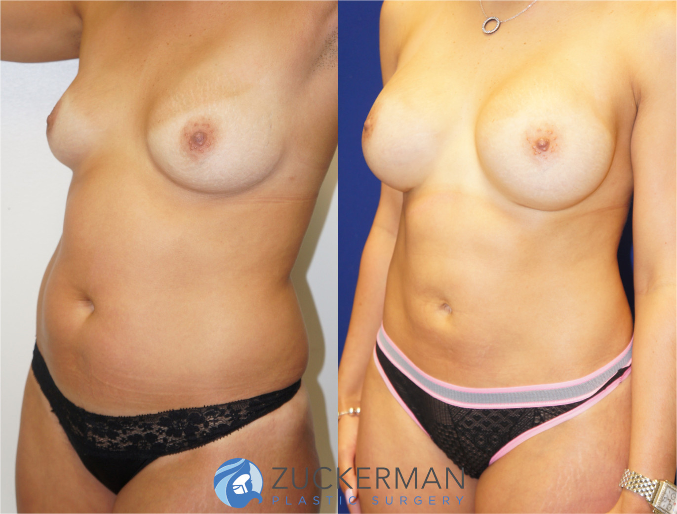 mommy makeover, before and after, breast augmentation, tummy tuck, liposuction, 2, joshua zuckerman md, nyc, right oblique view