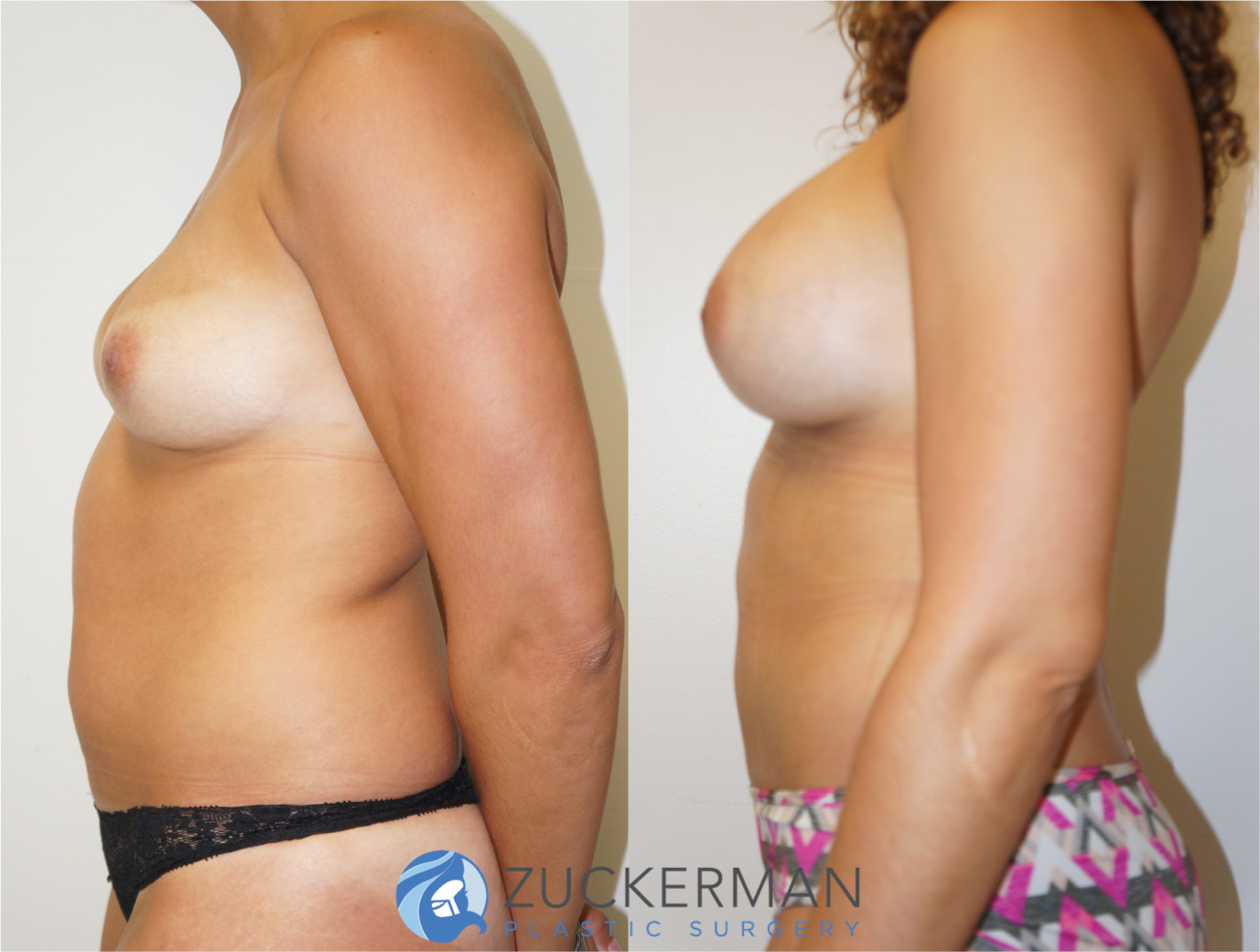 mommy makeover, before and after, breast augmentation, tummy tuck, liposuction, 2, joshua zuckerman md, nyc, right profile view