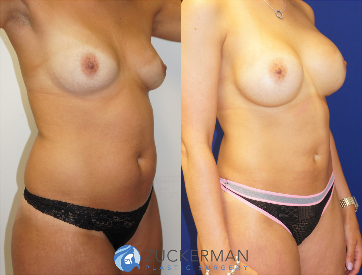 mommy makeover, before and after, breast augmentation, tummy tuck, liposuction, 2, joshua zuckerman md, nyc, left oblique view