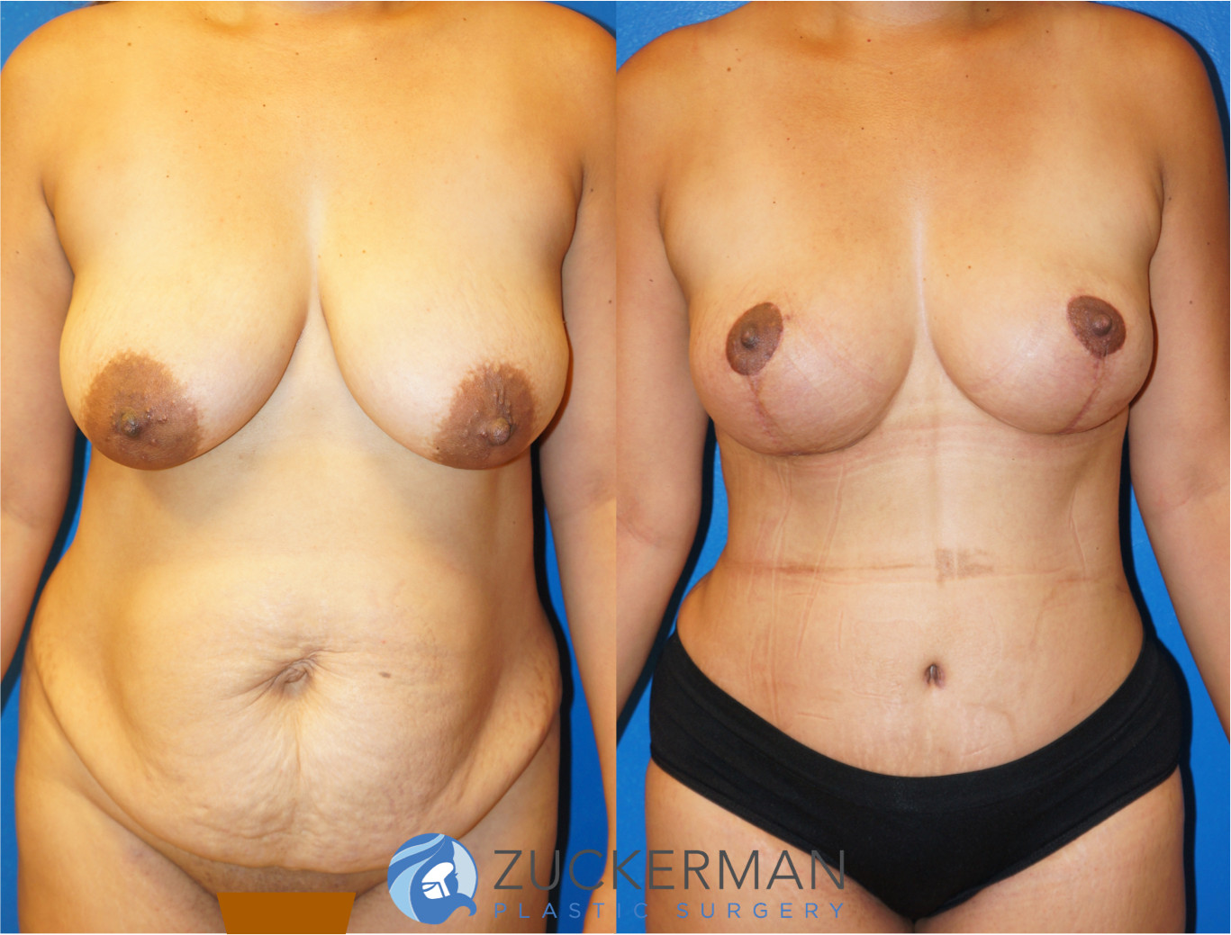 mommy makeover, before and after, breast lift, mastopexy, tummy tuck, liposuction, 3, joshua zuckerman md, nyc, frontal view