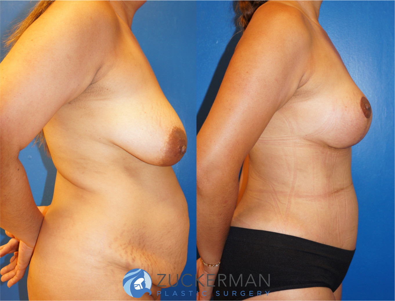 mommy makeover, before and after, breast lift, mastopexy, tummy tuck, liposuction, 3, joshua zuckerman md, nyc, right profile view