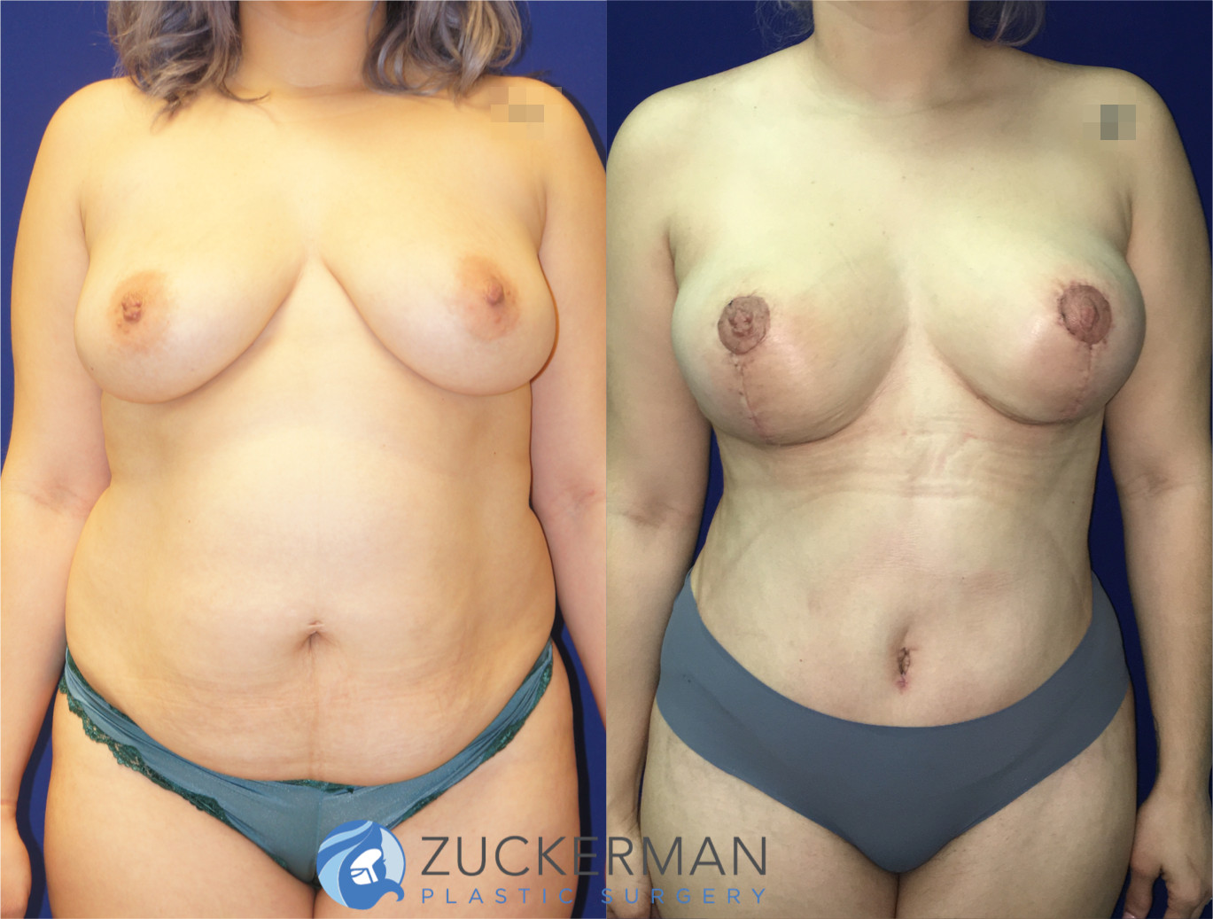 mommy makeover, before and after, breast lift, mastopexy, tummy tuck, liposuction, 4, joshua zuckerman md, nyc, frontal view