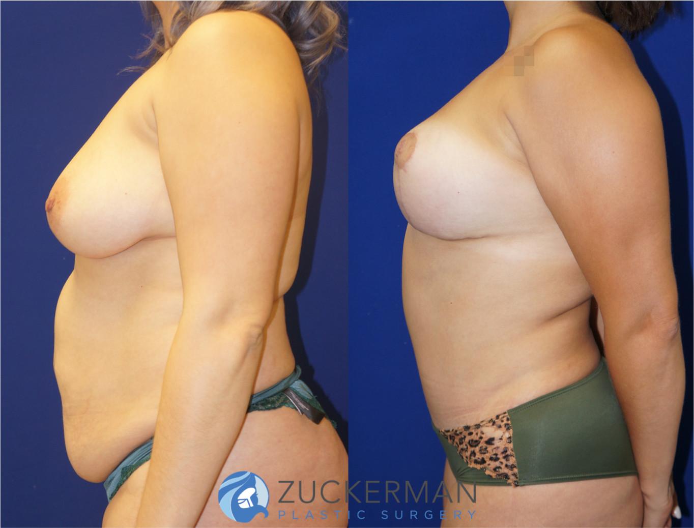 mommy makeover, before and after, breast lift, mastopexy, tummy tuck, liposuction, 4, joshua zuckerman md, nyc, left profile view