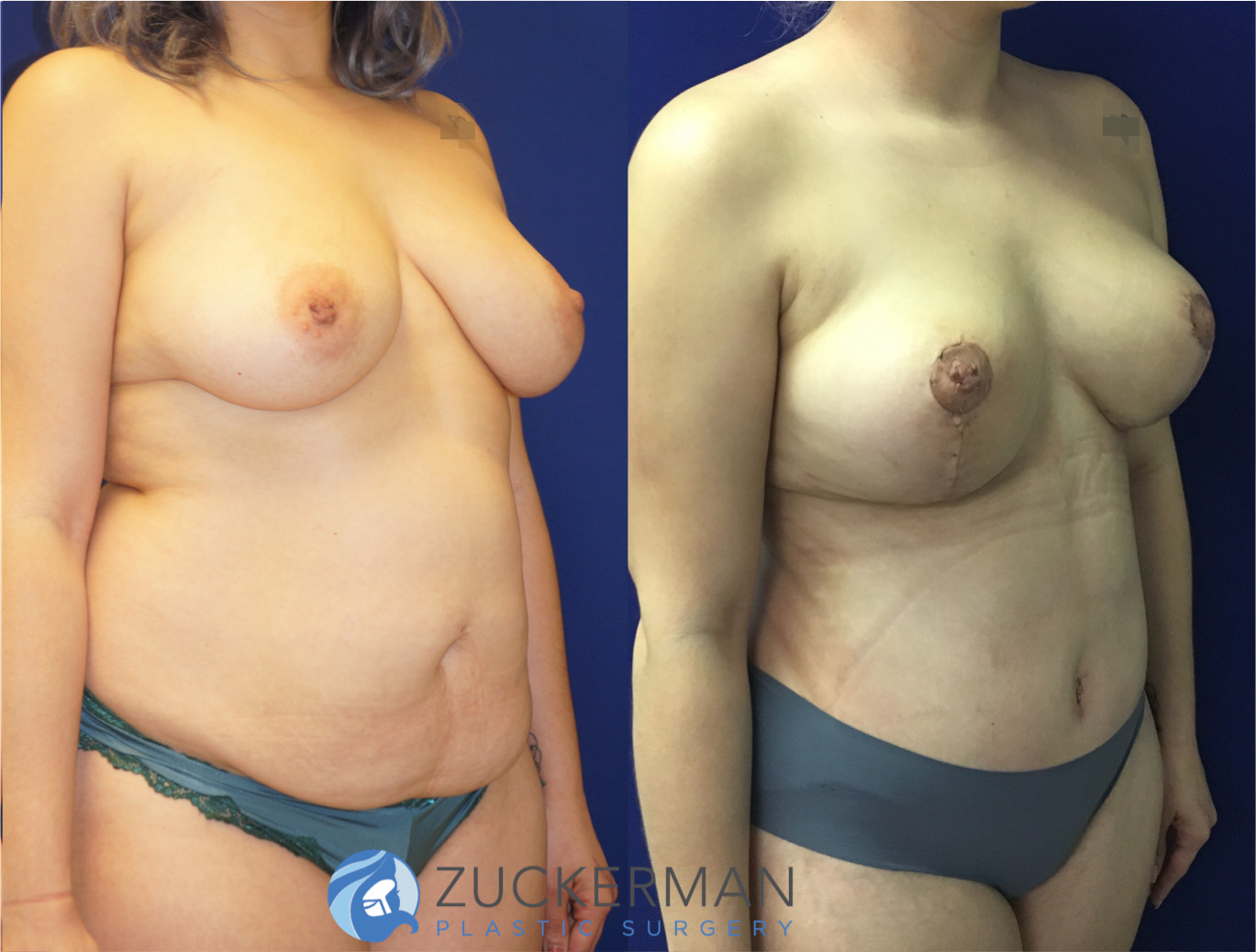 mommy makeover, before and after, breast lift, mastopexy, tummy tuck, liposuction, 4, joshua zuckerman md, nyc, right oblique view