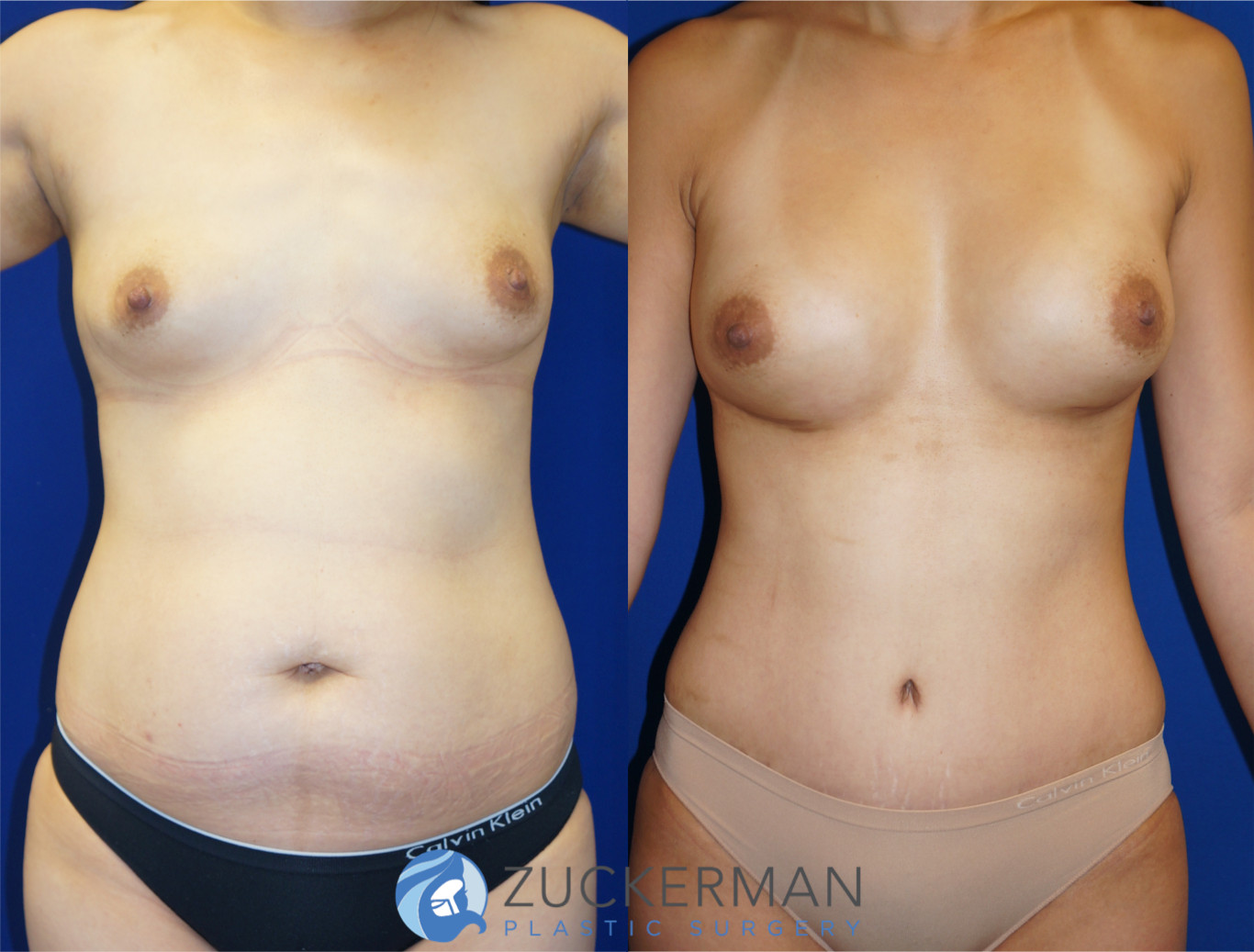 mommy makeover, before and after, breast augmentation, silicone breast implants, tummy tuck, liposuction, 5, joshua zuckerman md, nyc, frontal view
