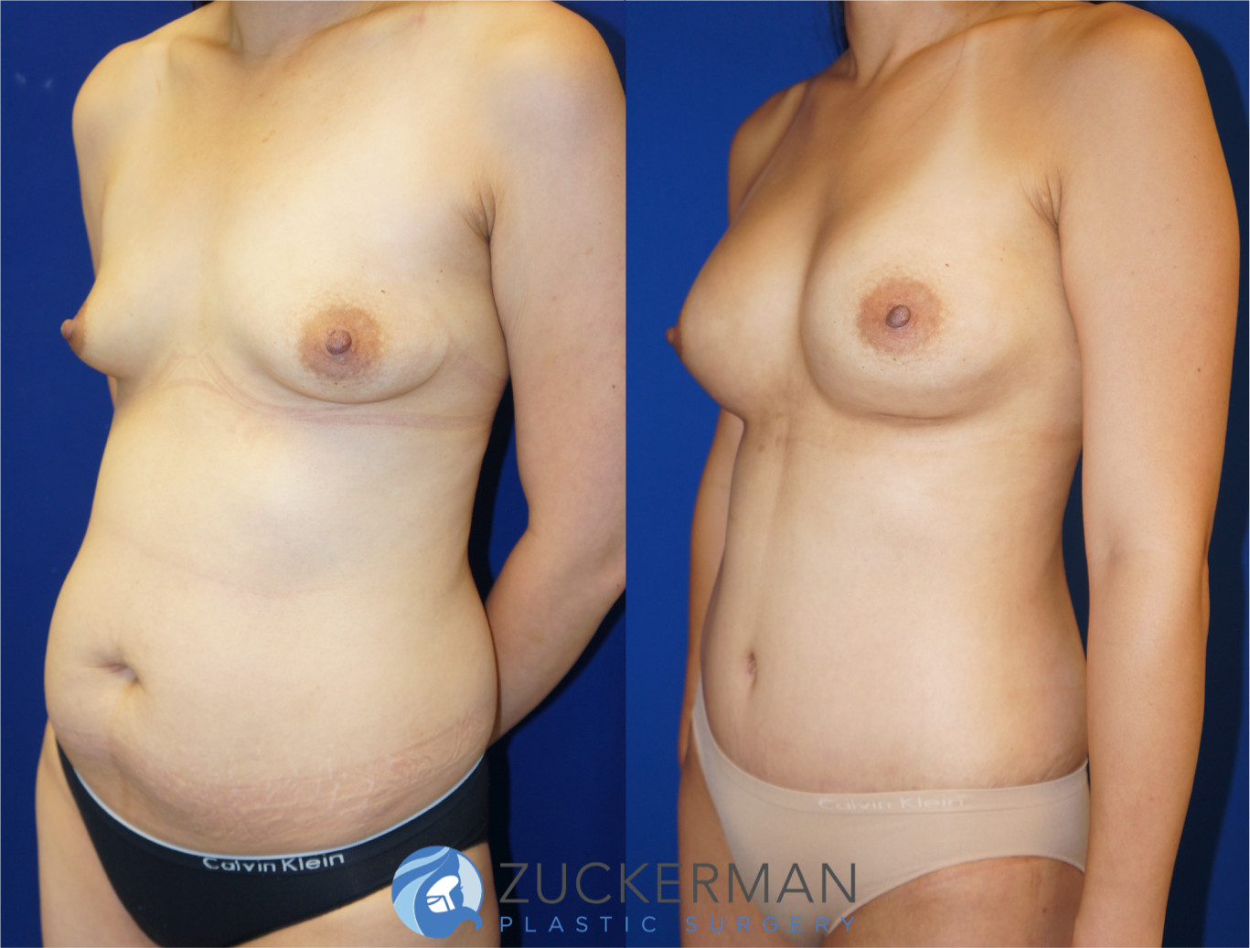 mommy makeover, before and after, breast augmentation, silicone breast implants, tummy tuck, liposuction, 5, joshua zuckerman md, nyc, left oblique view