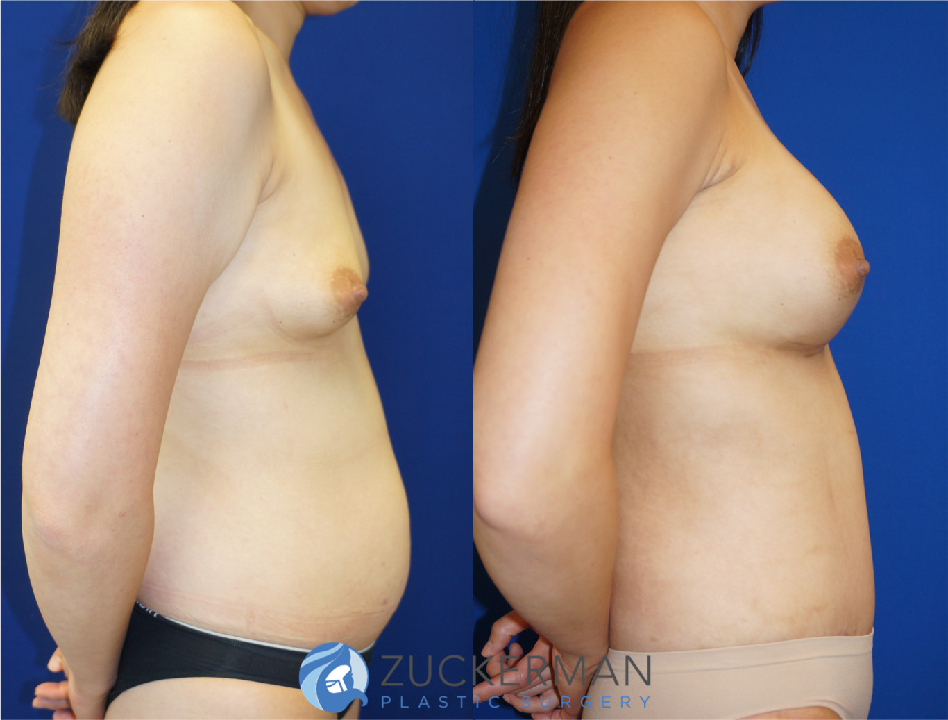 mommy makeover, before and after, breast augmentation, silicone breast implants, tummy tuck, liposuction, 5, joshua zuckerman md, nyc, right profile view