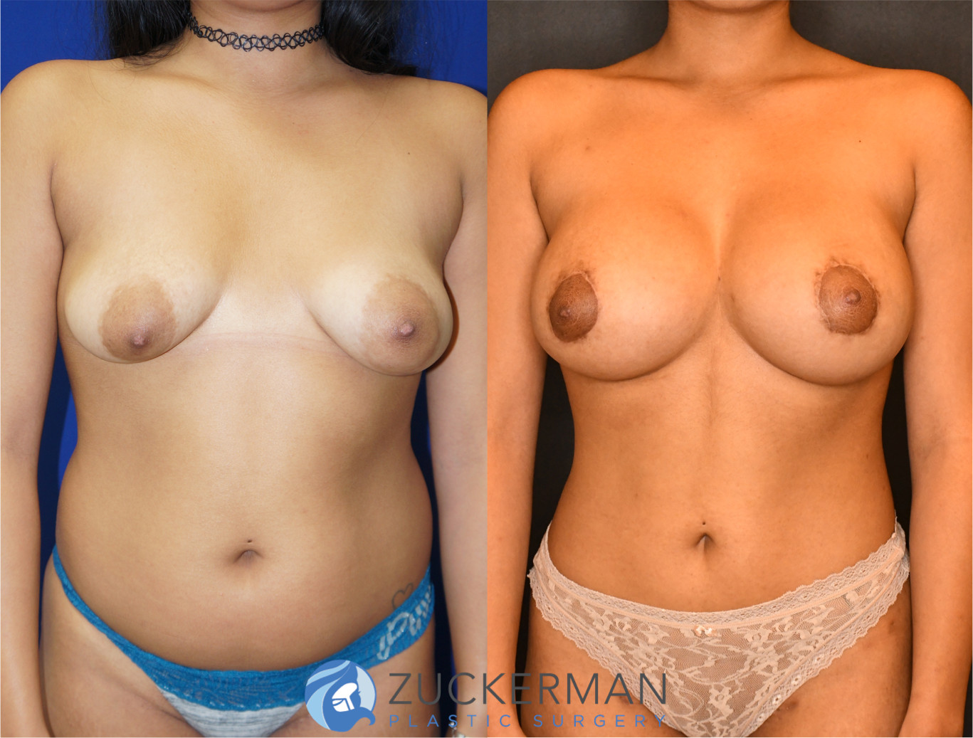 mommy makeover, before and after, breast augmentation, tuberous breasts, liposuction, joshua zuckerman md, nyc, frontal view, 6