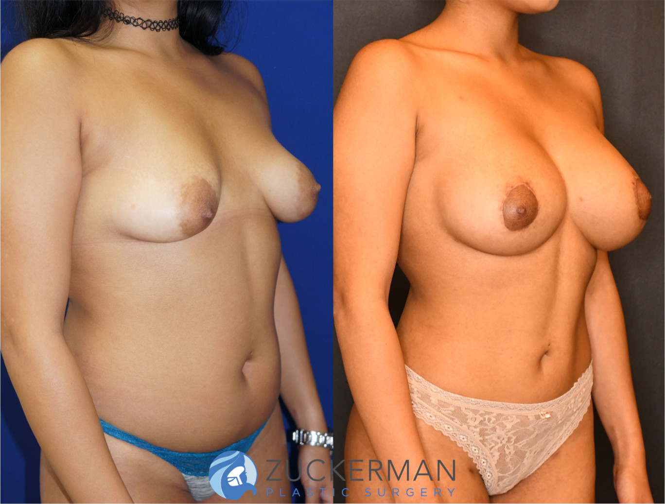 mommy makeover, before and after, breast augmentation, tuberous breasts, liposuction, joshua zuckerman md, nyc, left oblique view, 6