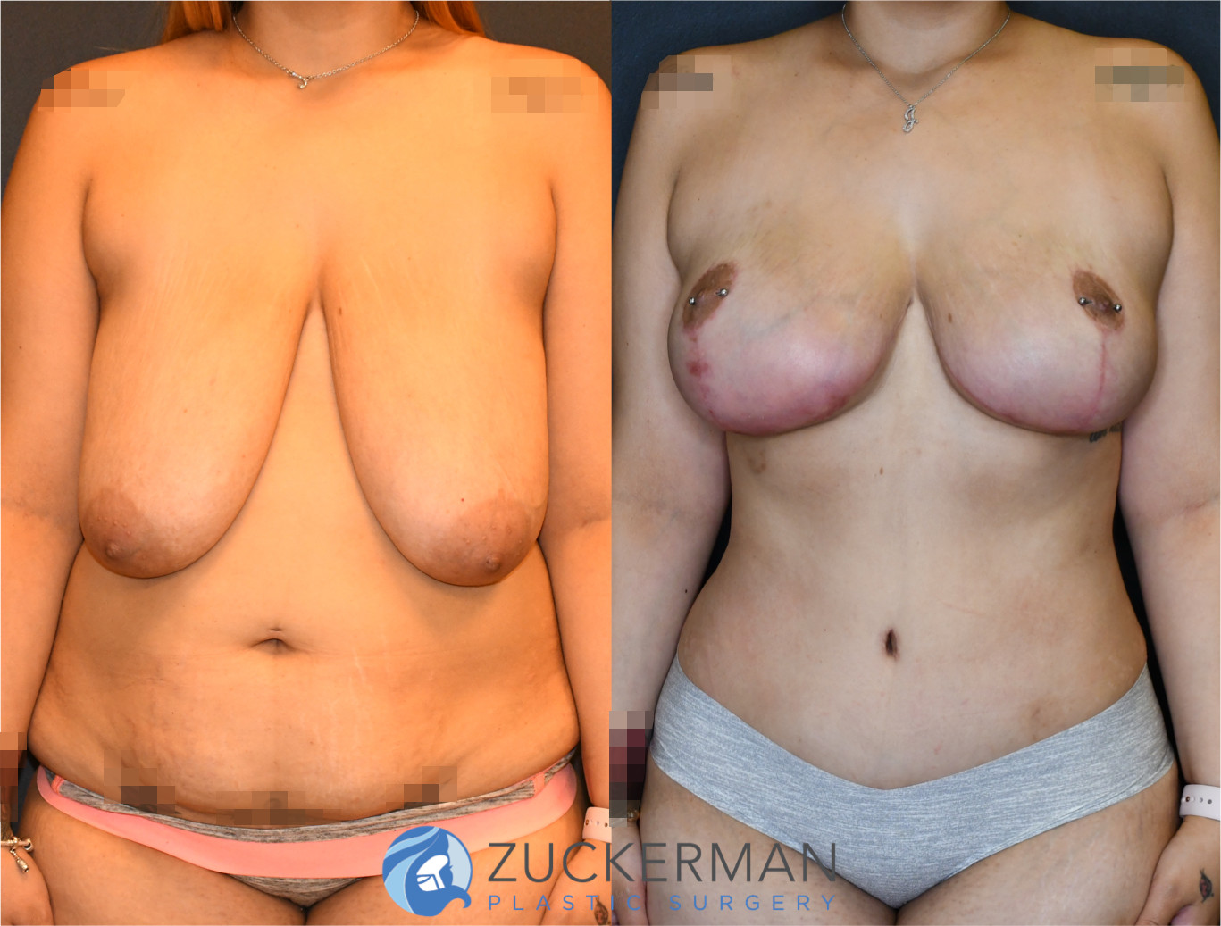 mommy makeover, before and after, breast lift, wise pattern, mastopexy, tummy tuck, liposuction, 7, joshua zuckerman md, nyc, frontal view
