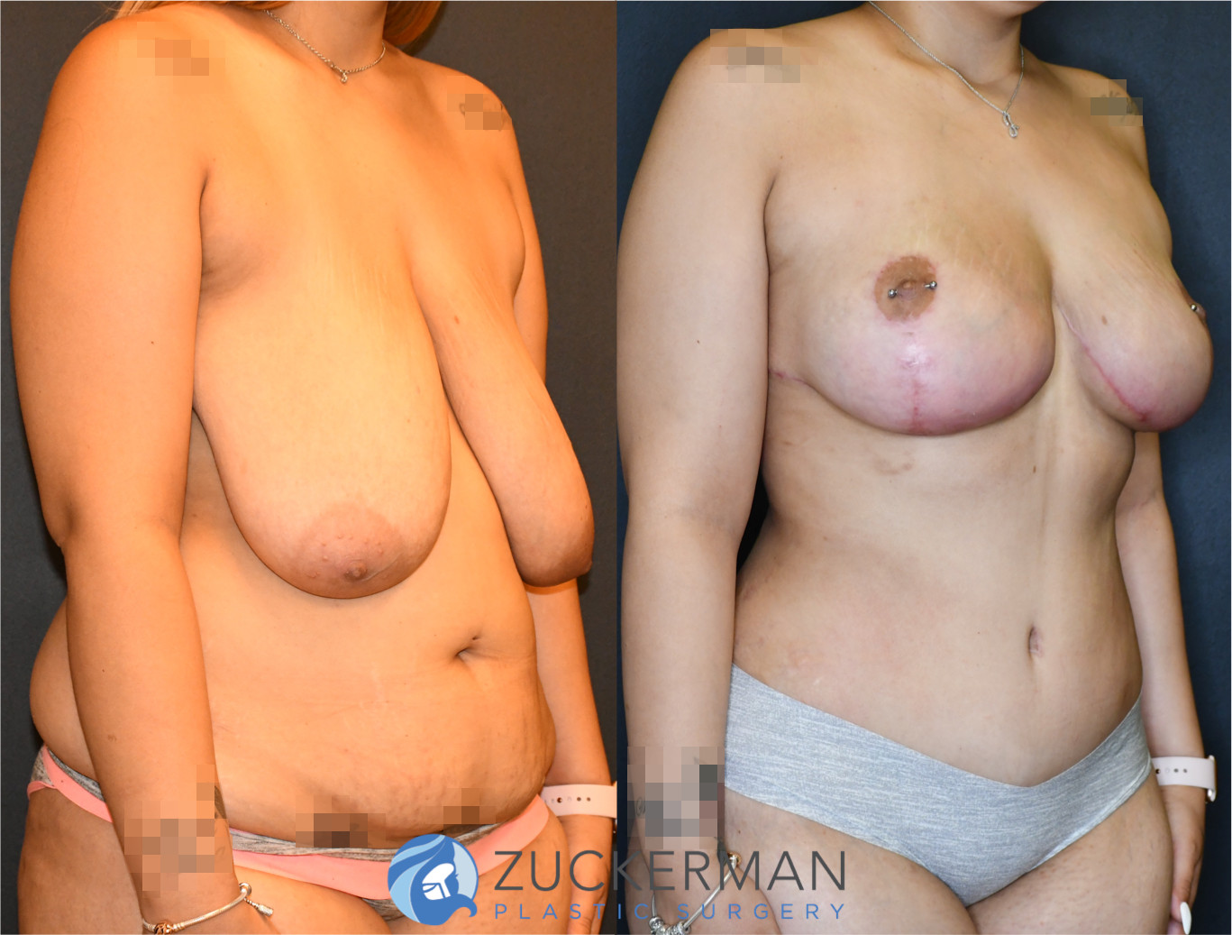 mommy makeover, before and after, breast lift, wise pattern, mastopexy, tummy tuck, liposuction, 7, joshua zuckerman md, nyc, right oblique view