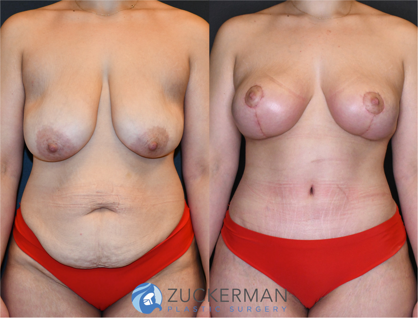 mommy makeover, before and after, breast lift, mastopexy, tummy tuck, liposuction, 8, joshua zuckerman md, nyc, frontal, view