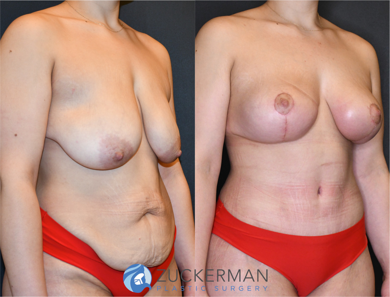 mommy makeover, before and after, breast lift, mastopexy, tummy tuck, liposuction, 8, joshua zuckerman md, nyc, right oblique view