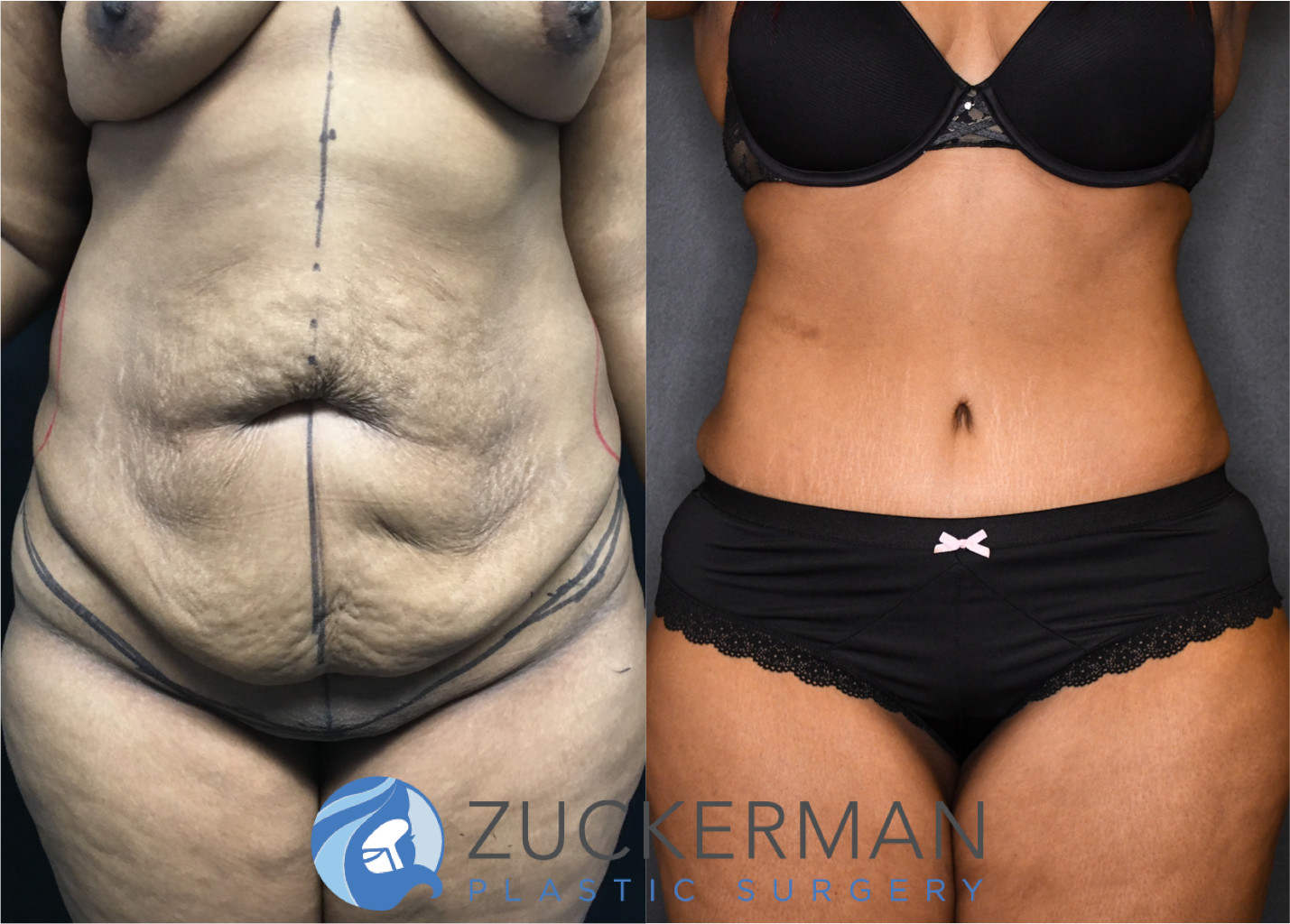 tummy tuck, abdominoplasty, post weight loss, body contouring, 12, frontal view, joshua zuckerman md, nyc