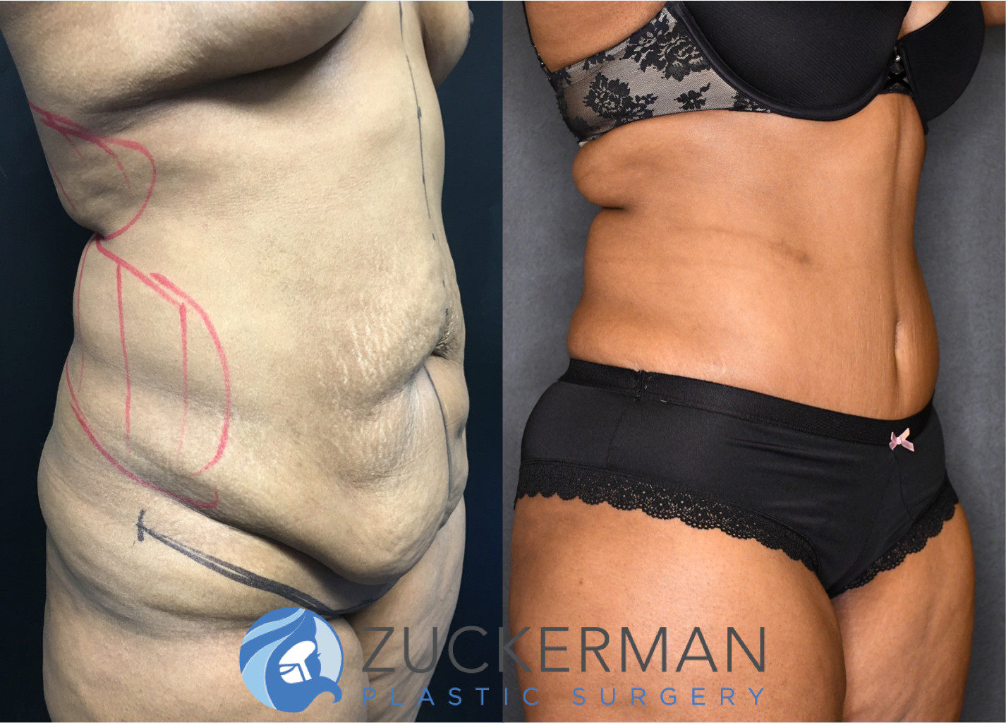 tummy tuck, abdominoplasty, post weight loss, body contouring, 12, right oblique view, joshua zuckerman md, nyc