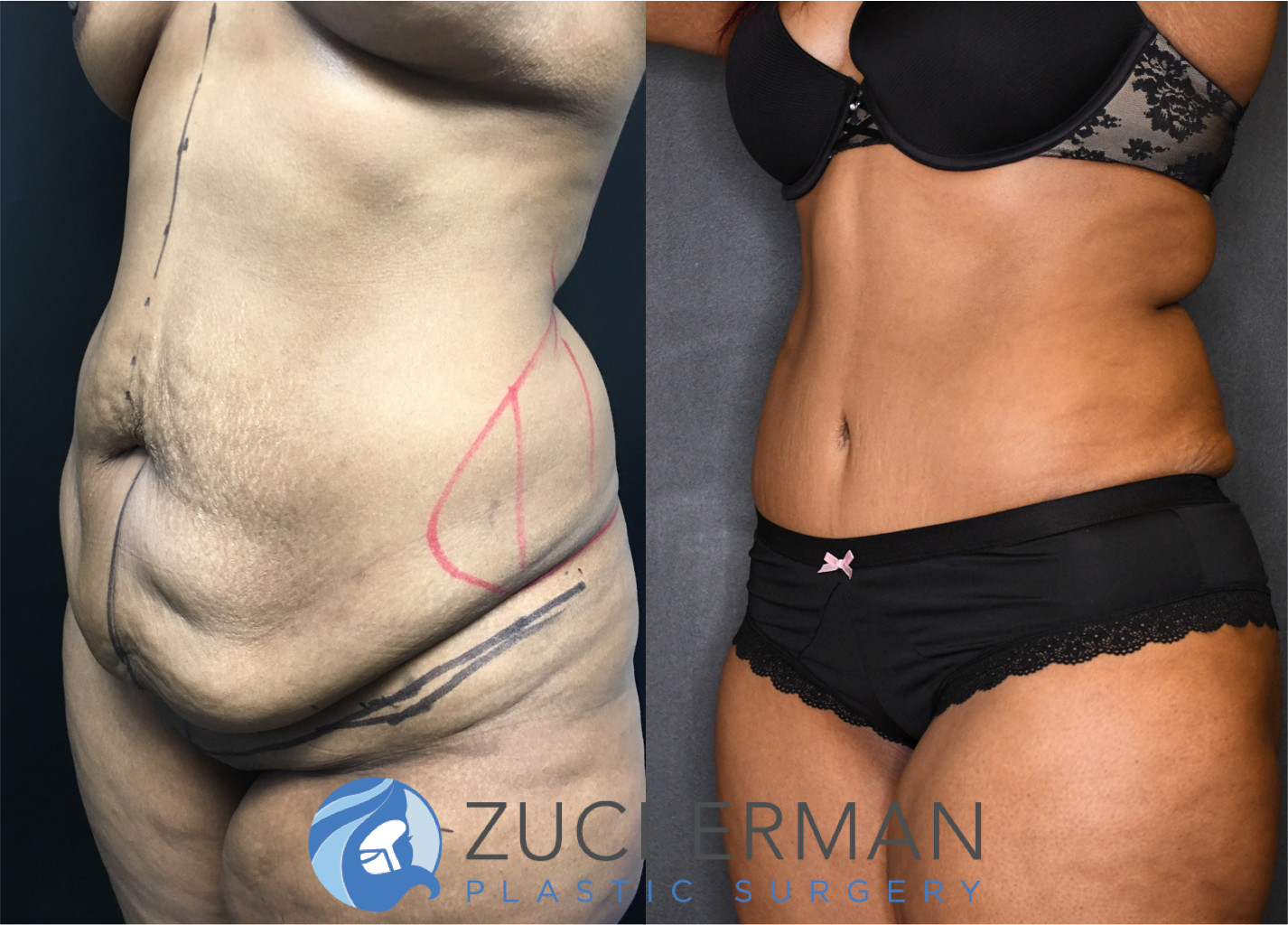 tummy tuck, abdominoplasty, post weight loss, body contouring, 12, left oblique view, joshua zuckerman md, nyc