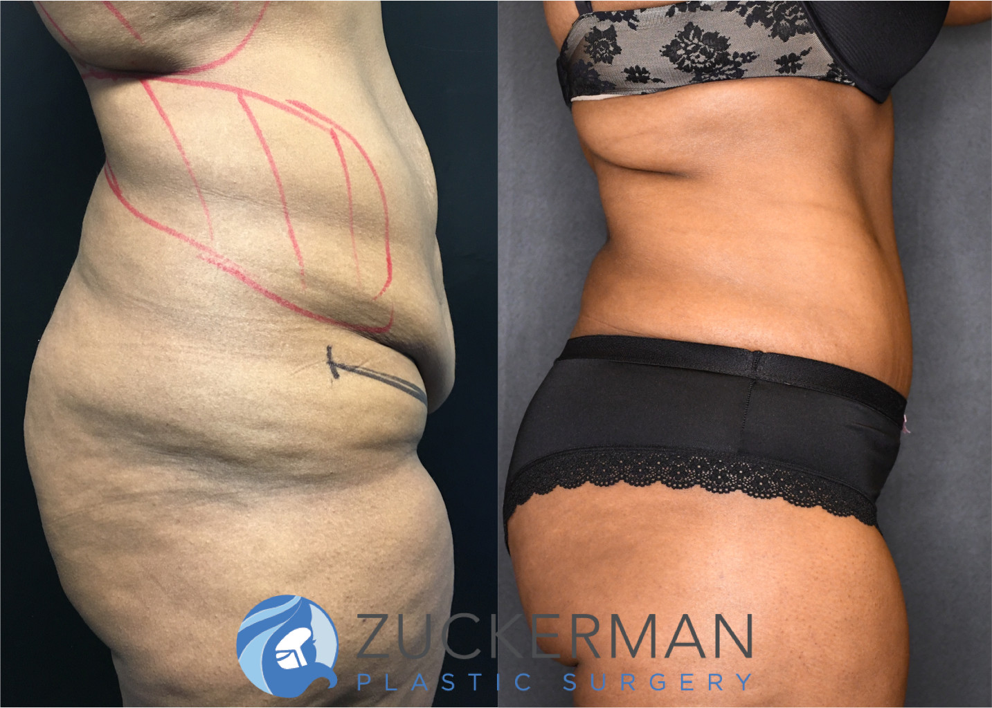 tummy tuck, abdominoplasty, post weight loss, body contouring, 12, right profile view, joshua zuckerman md, nyc