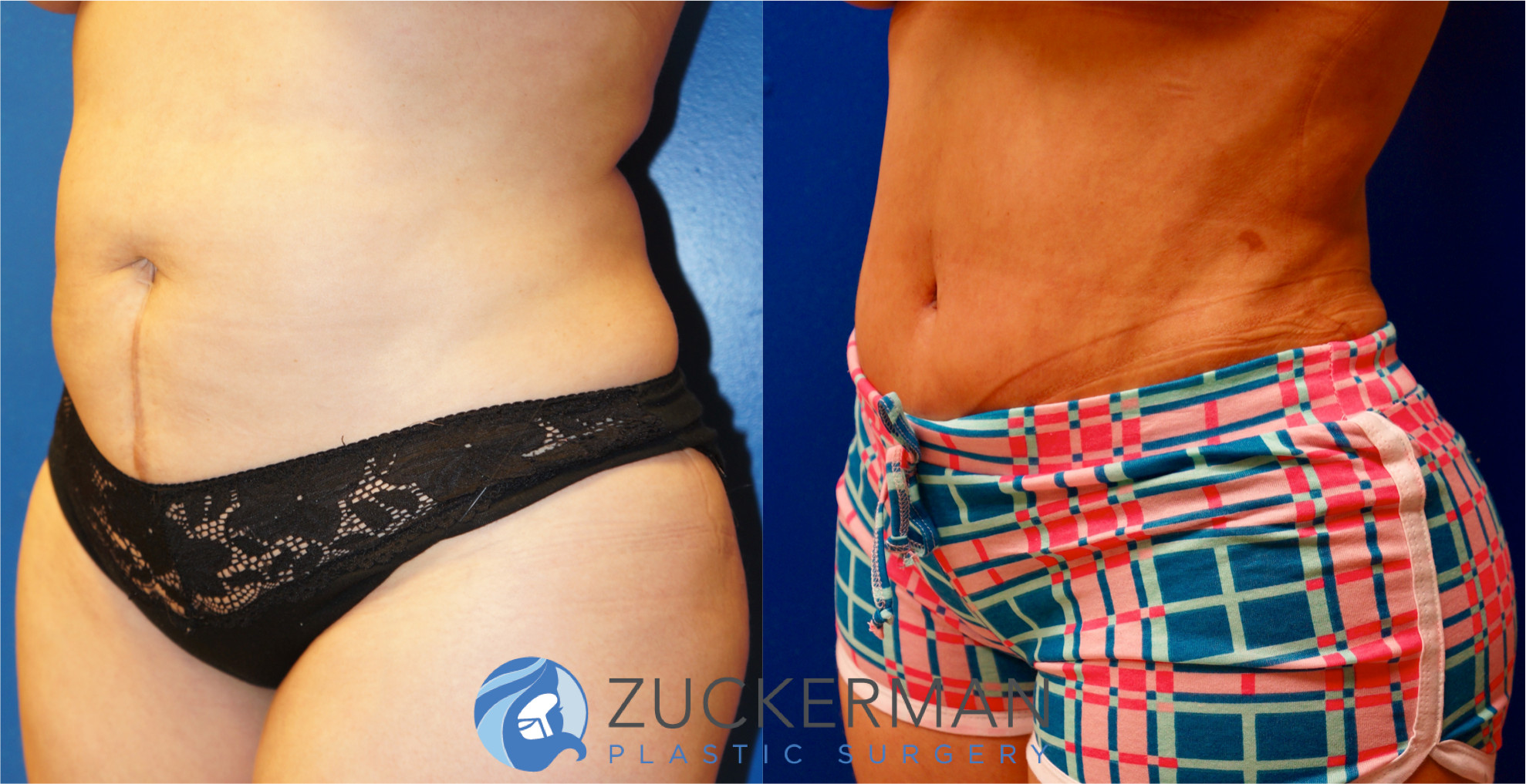 tummy tuck, abdominoplasty, left oblique view, 4, joshua zuckerman md, nyc