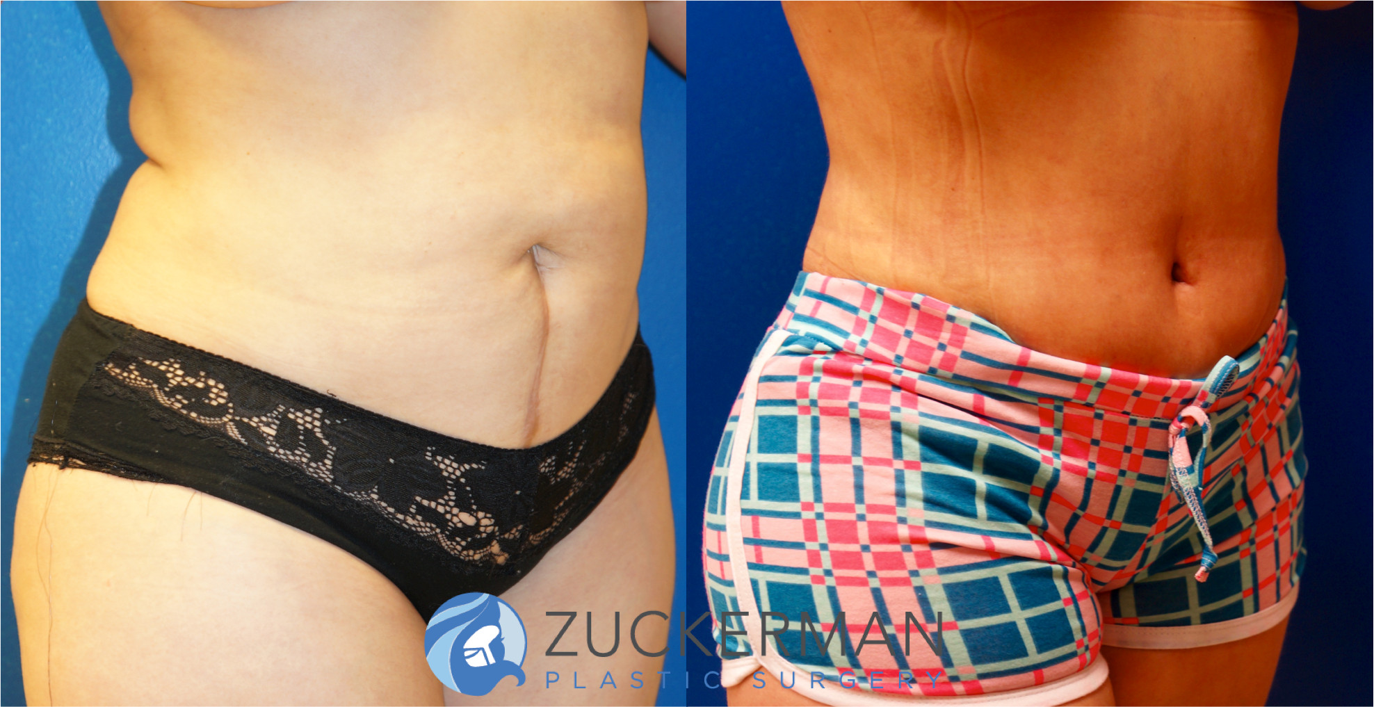 tummy tuck, abdominoplasty, right oblique view, 4, joshua zuckerman md, nyc