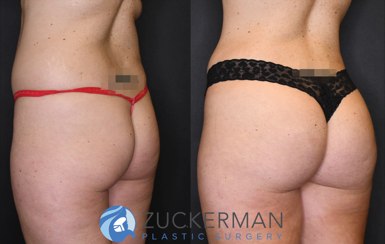 brazilian butt lift, buttock augmentation, bbl, before and after, joshua zuckerman, 13, posterior left oblique view