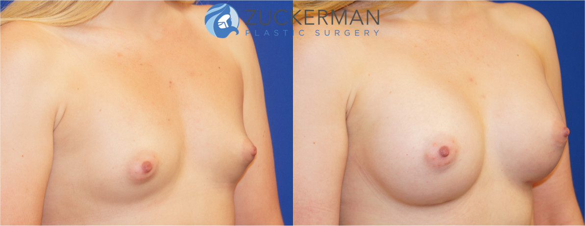 breast implants, before and after, featured, mentor, round, silicone, high profile, 4, right oblique