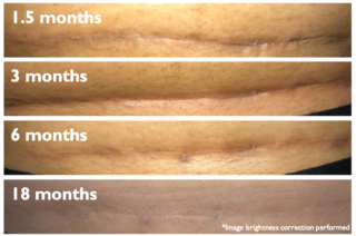 scar, healing, maturation, after plastic surgery, tummy tuck scar, breast lift scar